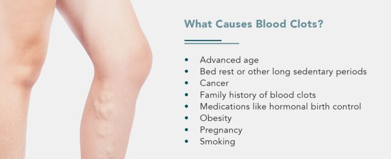 Using CT Scans for Finding Blood Clots | Envision Radiology